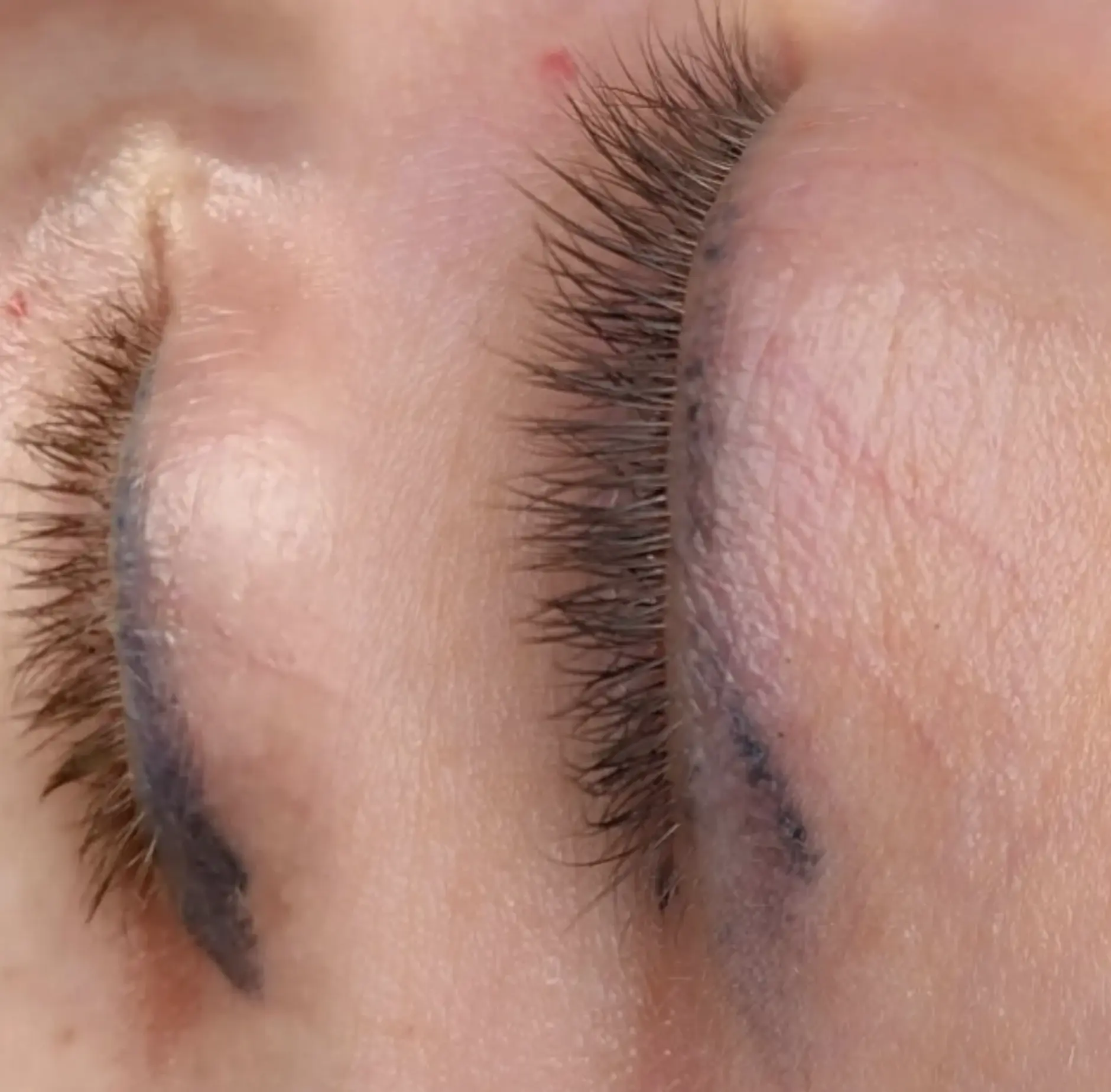 Can you reverse an eyeliner tattoo?